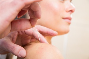 Doctor hands acupuncture needle pricking on woman patient closeu