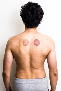 Man with marks from cupping therapy